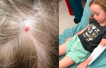 Por una garrapata, niña de cinco años sufrió extraña parálisis
