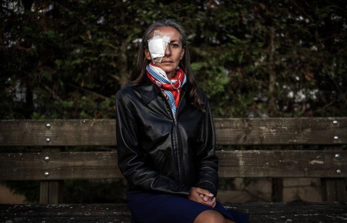 Corine Remande tras recibir un golpe con una bola de Golf en su ojo. Foto: AFP