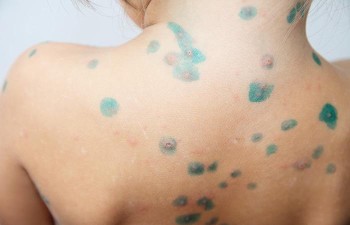 La enfermedad que erupciona lentamente la piel. Foto: Shutterstock