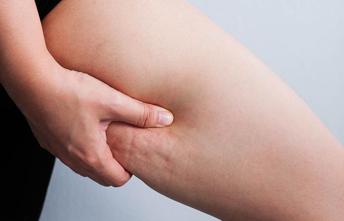 Generalmente afecta la piel en las piernas. Foto: Shutterstock