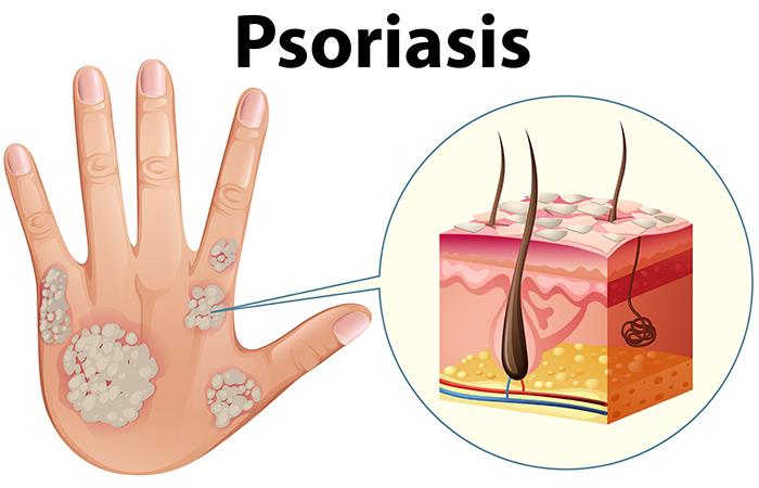 Arren de la forrás psoriasis