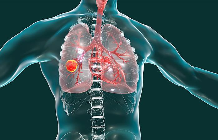 Existe un nuevo tipo de lesión en los pulmones. Foto: Shutterstock