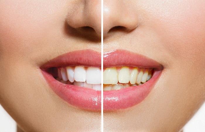 ¿Cómo blanquear los dientes con remedios naturales?. Foto: Shutterstock
