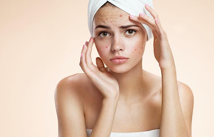 El acné no seguirá siendo un problema. Foto: Shutterstock