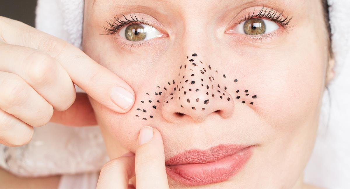 Remedio casero para eliminar los puntos negros del rostro. Foto: Shutterstock