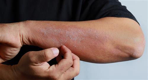 Dermatitis durante la pandemia: Qué tener en cuenta y cuándo acudir al médico
