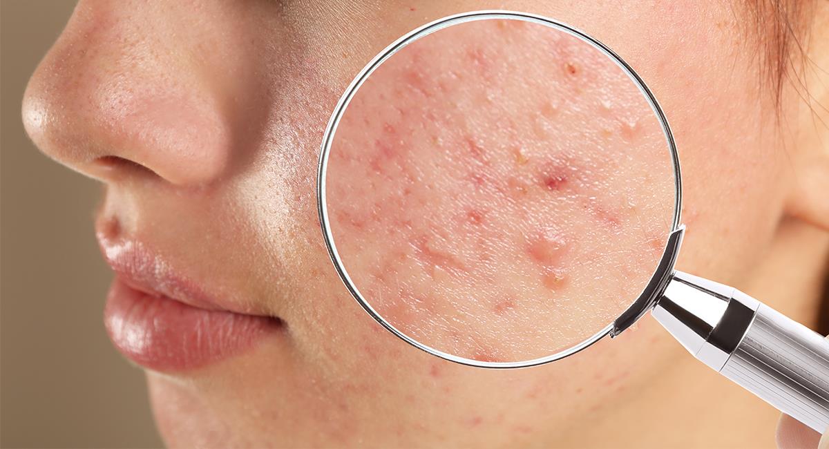 Gana la batalla contra el acné con estos 4 increíbles trucos. Foto: Shutterstock