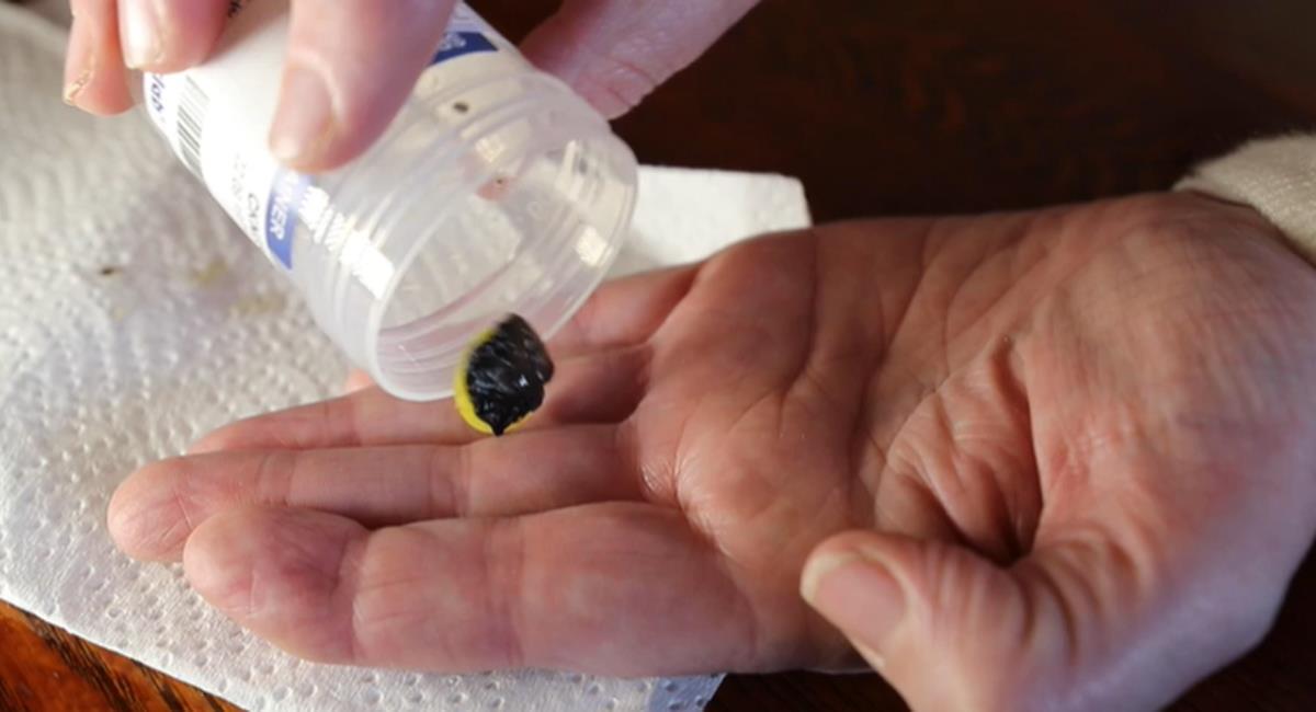 Una ficha de plástico permaneció 37 años alojada en la cavidad nasal de una mujer de Nueva Zelanda. Foto: Captura de video