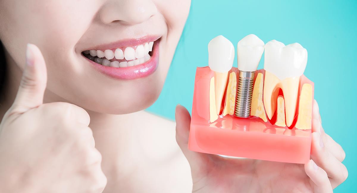 Método permitiría que la encía se regenere alrededor de los implantes dentales. Foto: Shutterstock