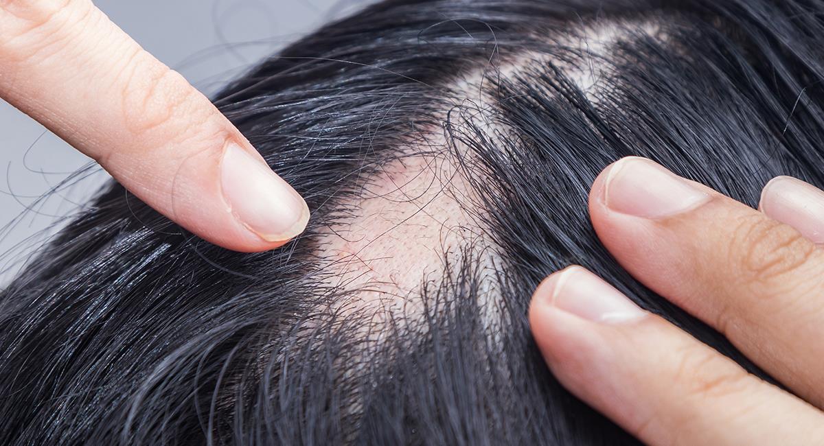 Alopecia femenina: así es el problema que sufre la esposa de Will Smith. Foto: Shutterstock