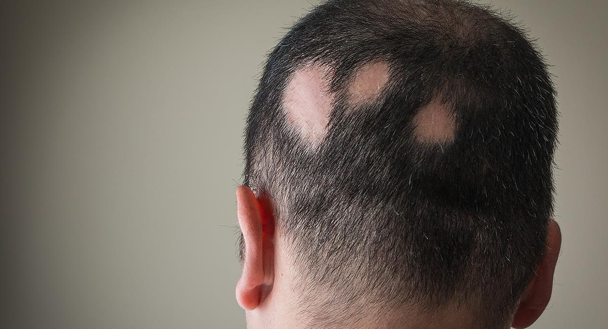 Aprueban el primer medicamento para tratar la alopecia severa. Foto: Shutterstock