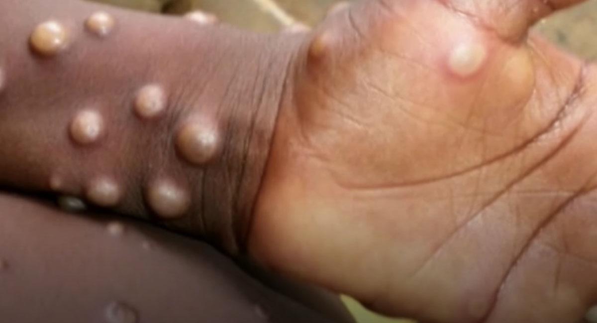 La viruela del mono es una enfermedad originaria de países de África central y occidental. Foto: Youtube