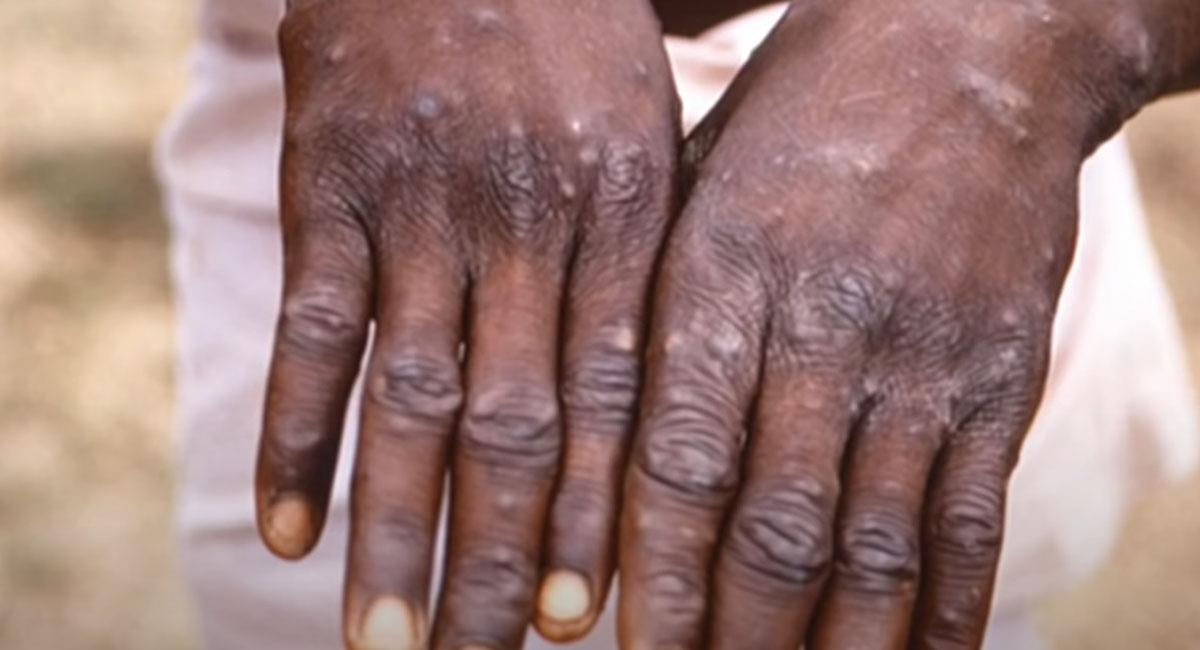 La viruela símica es originaria de países del occidente y centro de África. Foto: Youtube