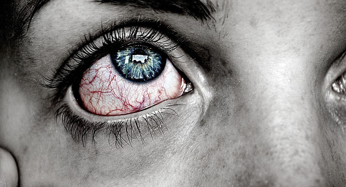 Si tienes una conjuntivitis viral, es probable que te puedes contagiar ambos ojos. Foto: Pixabay