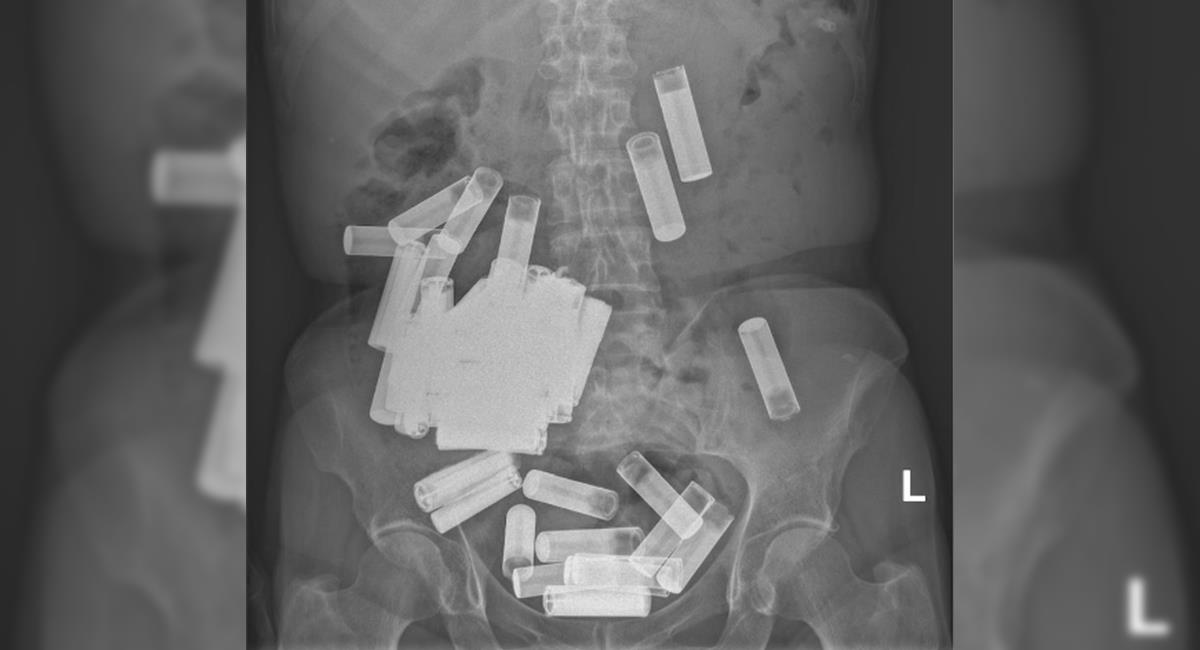 Mujer intentó hacerse daño tragando más de 50 pilas AA y AAA: así fue como la salvaron. Foto: Irish Medical Journal
