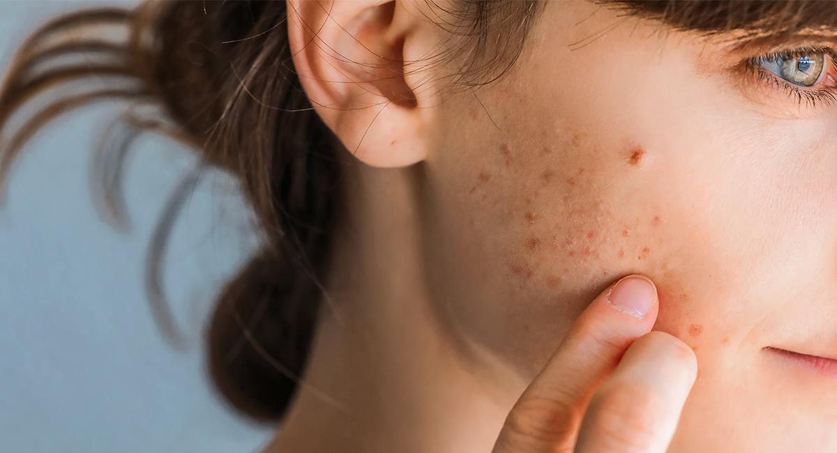 Mujer descubrió que tenía cáncer por bulto en el rostro que confundió con un grano. Foto: Shutterstock