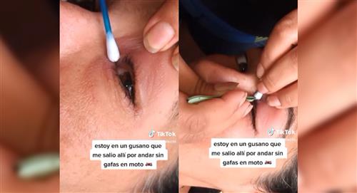 Mujer sufrió infección por un gusano en su ojo