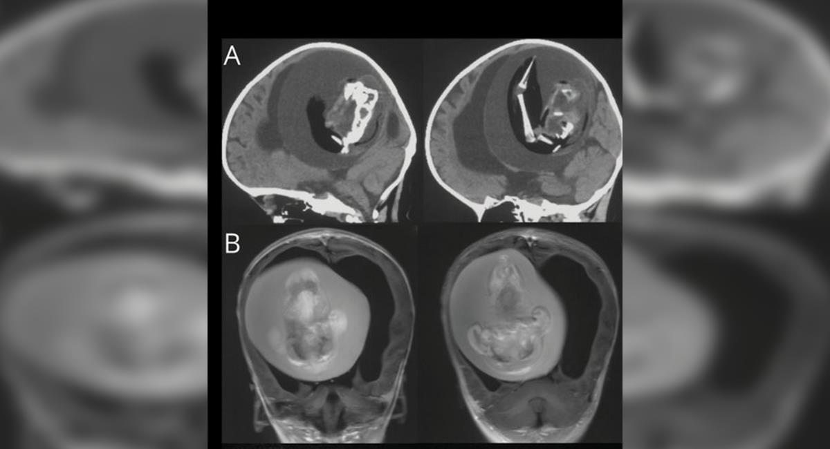 Descubren un feto en el cráneo de una niña de 1 año. Foto: Revista Neurology
