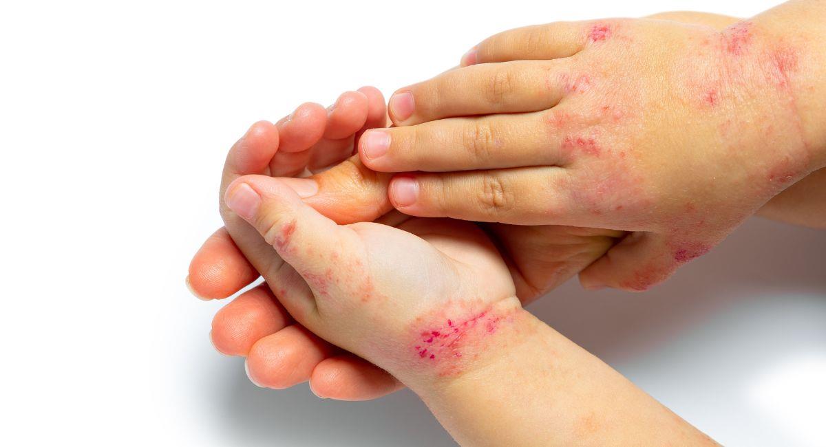 El calvario que tienen que sufrir los pacientes con dermatitis atópica. Foto: Shutterstock