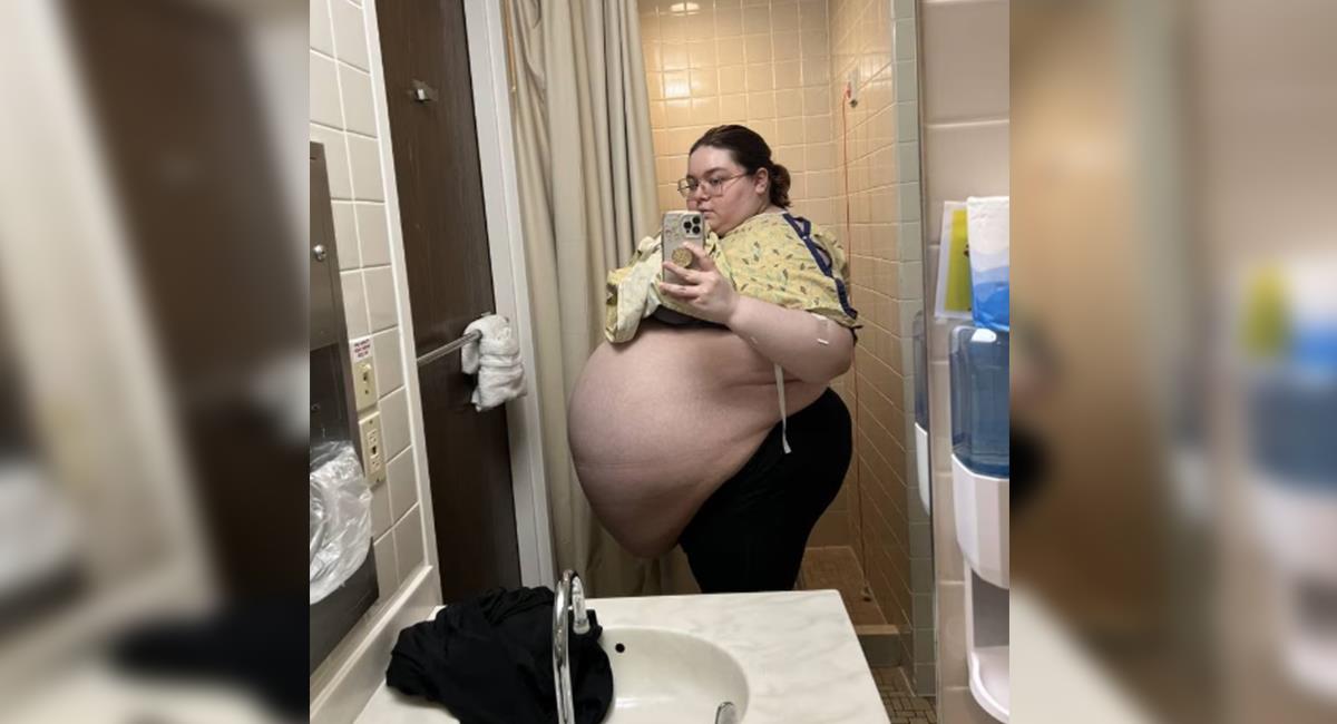 Mujer creyó que su gran barriga era por obesidad, pero era un tumor de 104 libras. Foto: Action News Jax