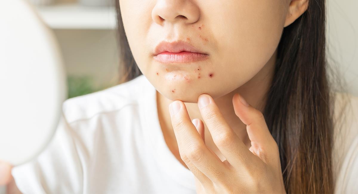 Poderosa oración para que se curen tus heridas, llagas o el acné. Foto: Shutterstock