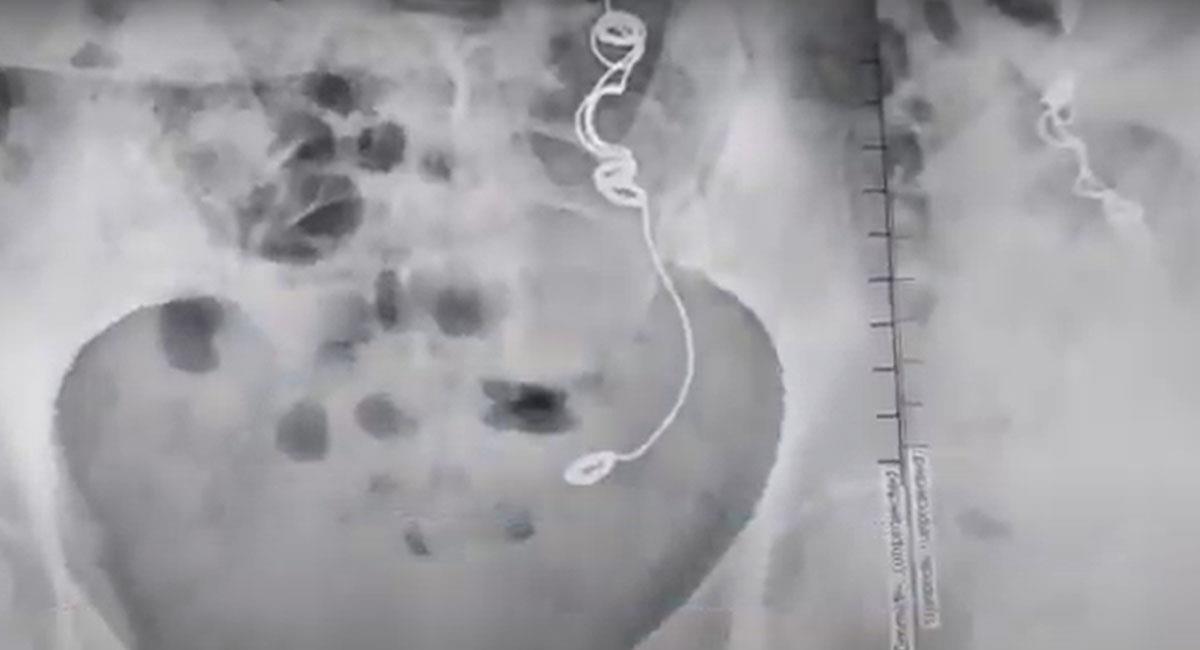 Una aguja con hilo fue dejada en el interior del organismo de una mujer en Guaviare hace 10 años. Foto: Youtube