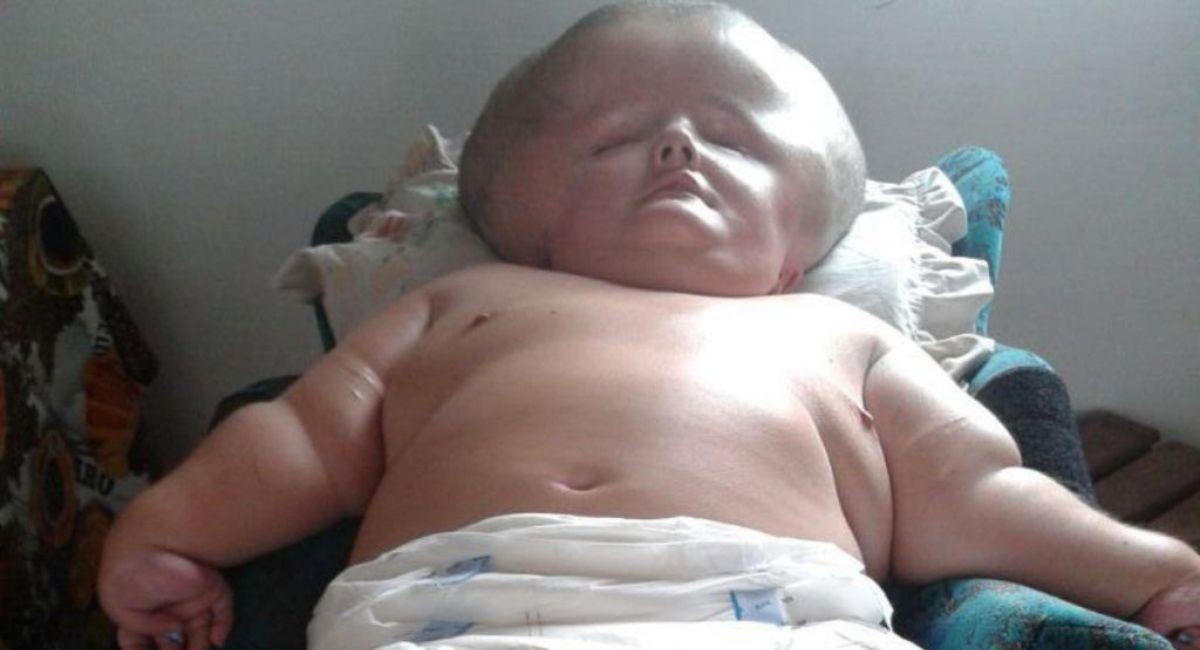 La “bebé gigante” con hidrocefalia que ha logrado vivir 29 años. Foto: Instagram @adalgisasoaresalves