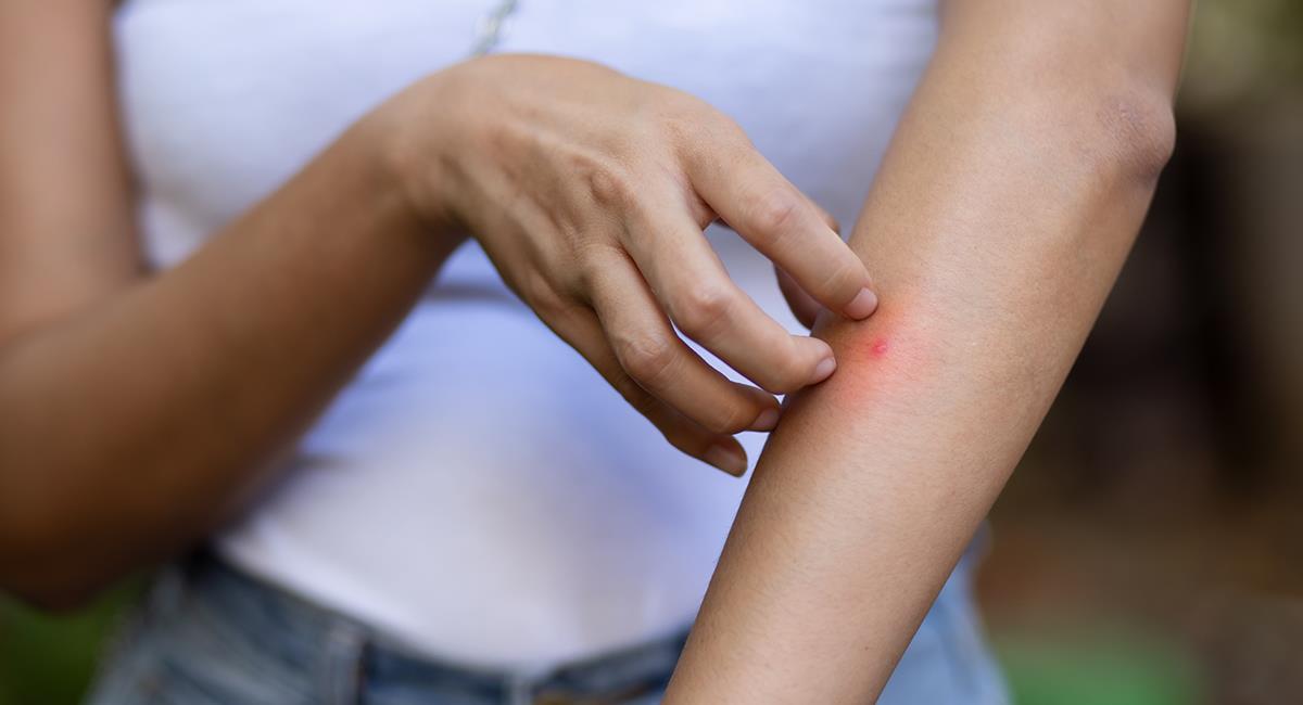 Picaduras de mosquitos: trucos para aliviar los síntomas y acelerar la curación. Foto: Shutterstock
