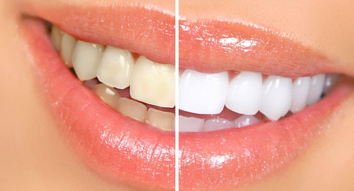 5 consejos para mantener los dientes blancos de forma natural. Foto: Shutterstock