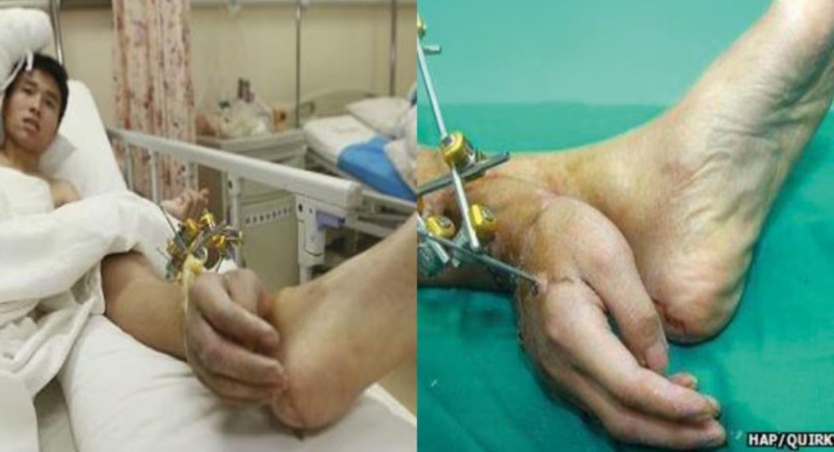 Hombre perdió su mano y se la injertaron en el tobillo para salvarlo. Foto: Youtube Nexo Digital Noticias