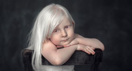 Albinismo: mitos y verdades más comunes