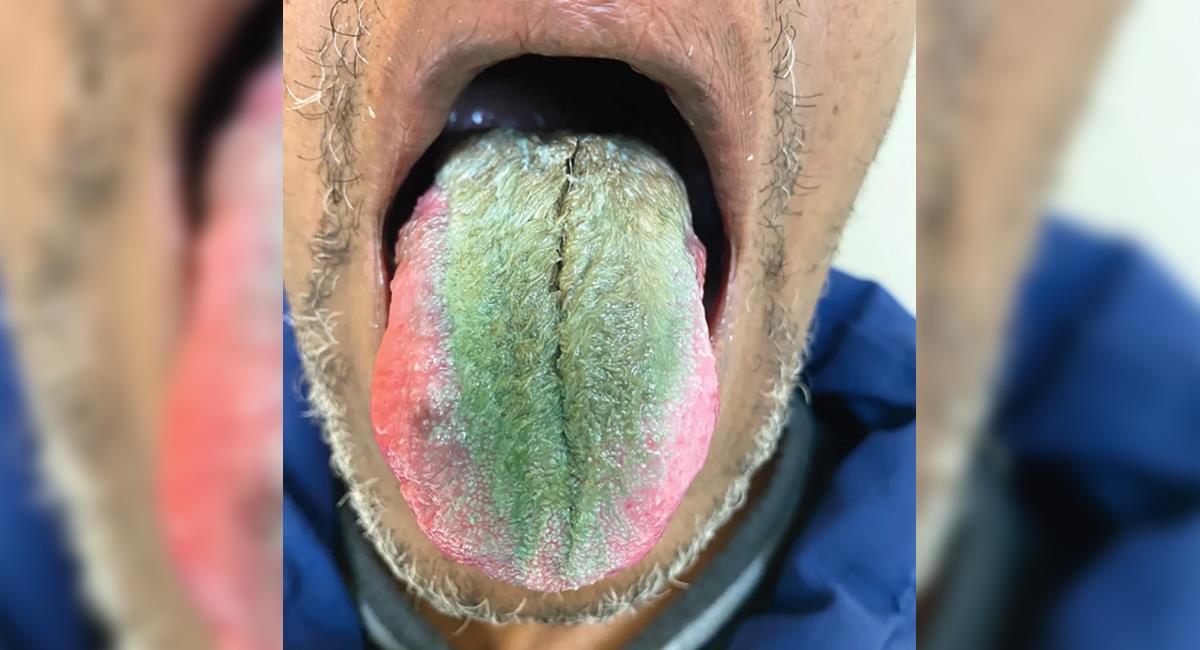 A hombre le salieron vellos en la lengua y se le puso verde: ¿por qué?. Foto: Shutterstock
