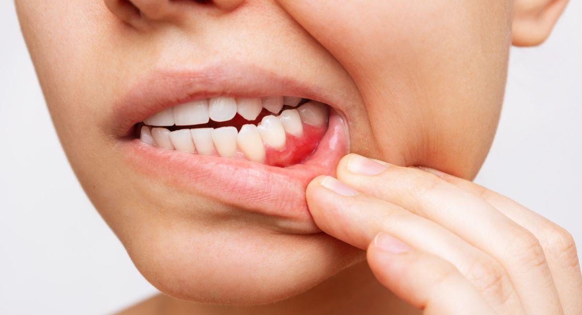 ¿Por qué me sangran las encías y cómo puedo evítalo?. Foto: Shutterstock