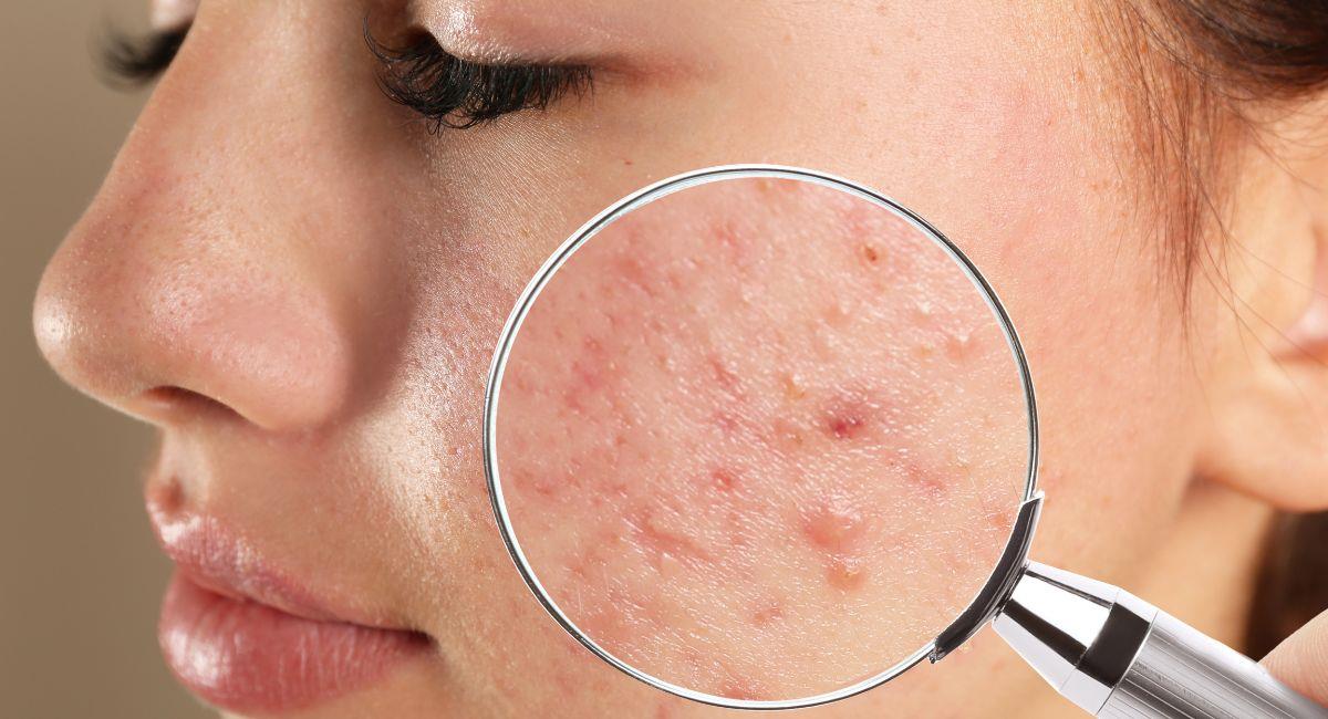 3 mascarillas efectivas con ajo para combatir el acné. Foto: Shutterstock