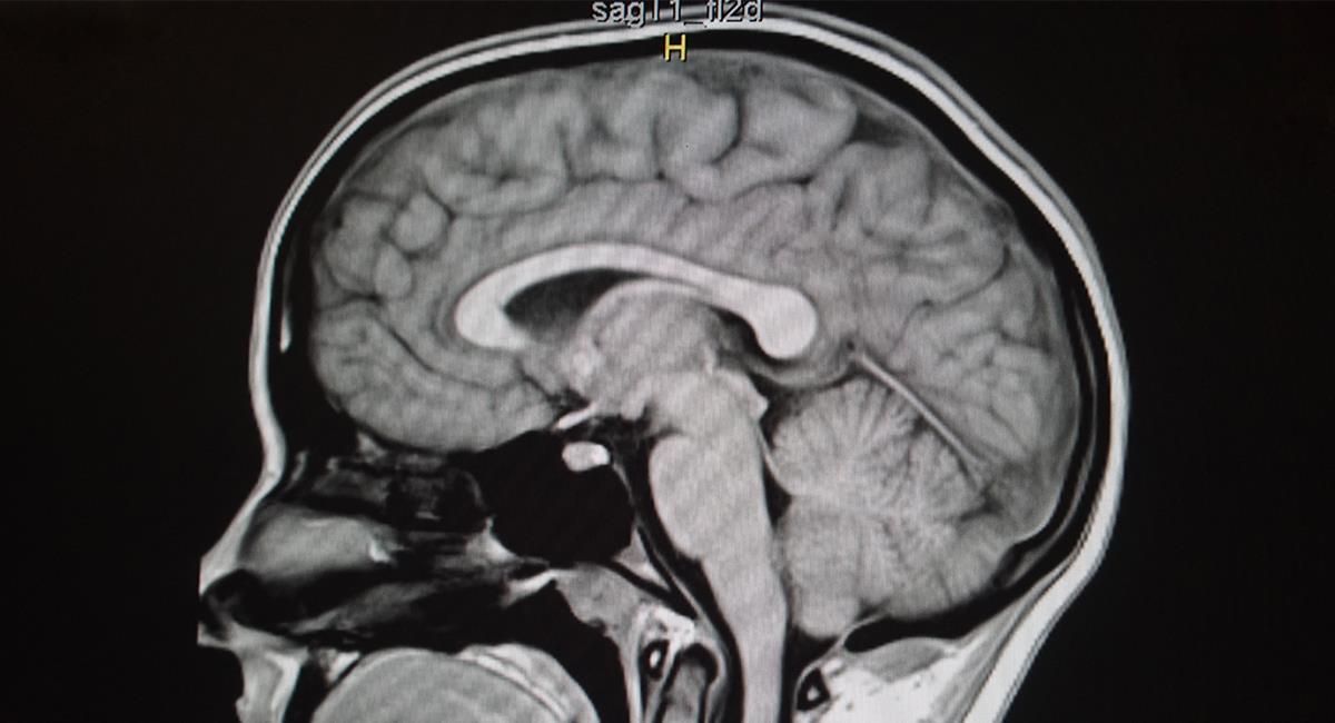 Mujer tenía una lombriz de 8 centímetros viviendo en su cerebro. Foto: Shutterstock
