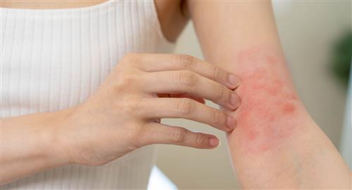 La dermatitis atópica afecta a la cuarta parte de la población mundial