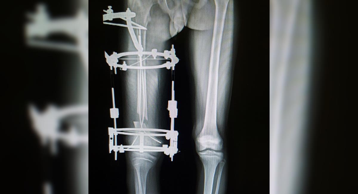 Alargamiento óseo: ¿cómo funciona la cirugía que se hizo Yeferson Cossio?. Foto: Shutterstock