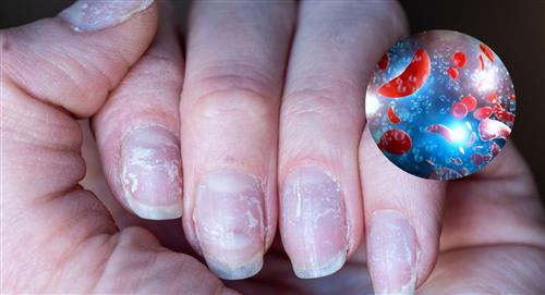 ¿Cómo saber si tengo anemia observando mis uñas?