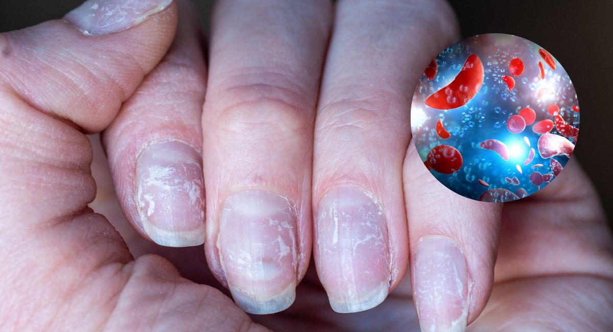 ¿Cómo saber si tengo anemia observando mis uñas?. Foto: Shutterstock