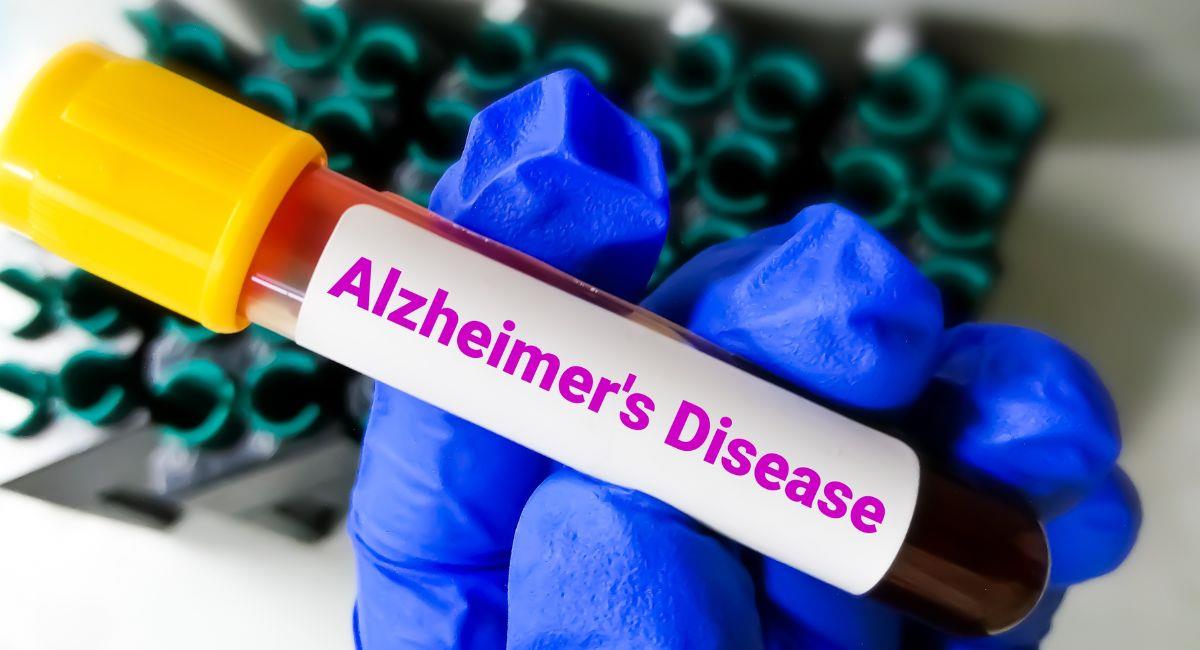 Este análisis de sangre puede detectar el Alzheimer de forma temprana. Foto: Shutterstock