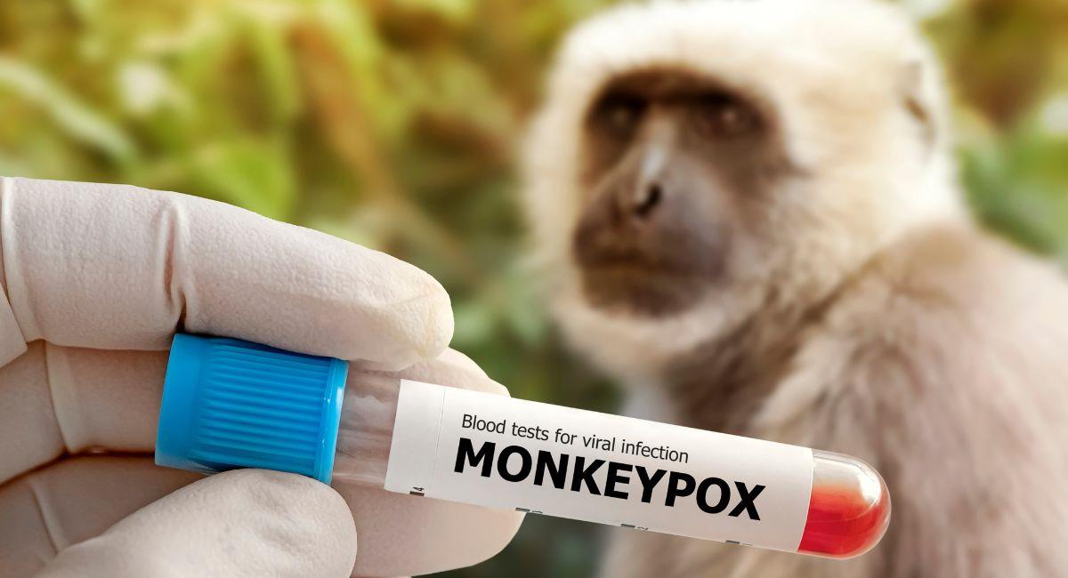 Colombia en la lista de los 5 países con más contagios de viruela del mono. Foto: Shutterstock