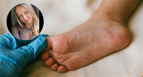 Enfermedad de manos, pies y boca: el virus del hijo de Laura Acuña