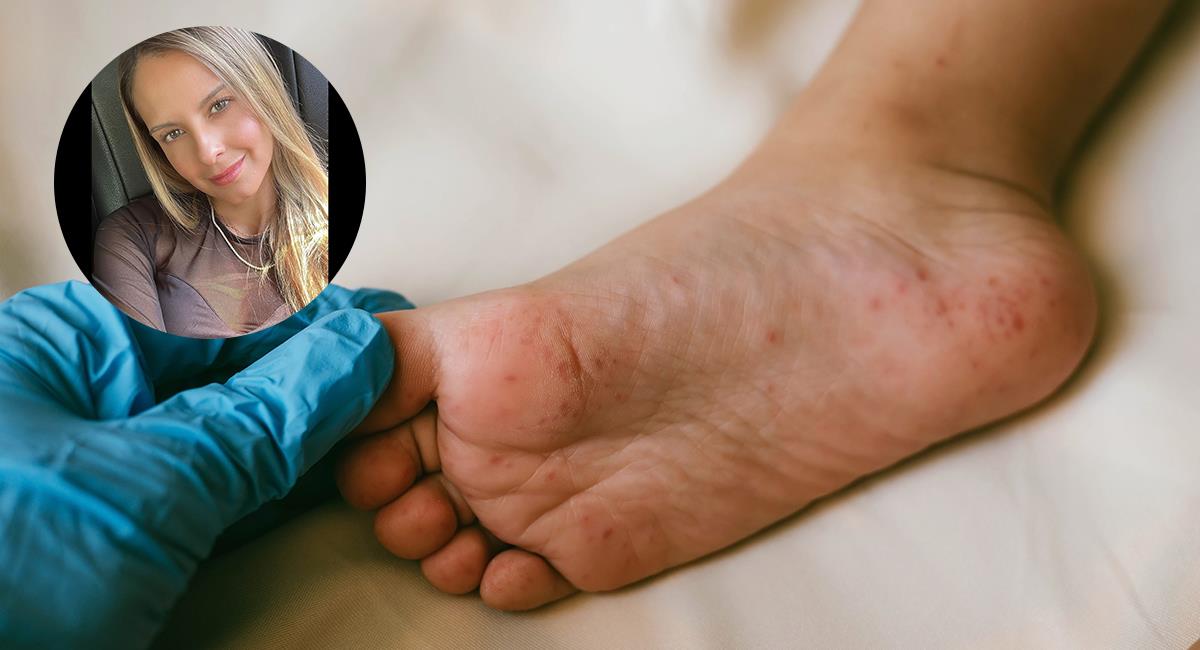 Hijo de Laura Acuña se contagió de la enfermedad de manos, pies y boca: ¿cómo es el virus?. Foto: Shutterstock /Instagram @lauraacunaayala