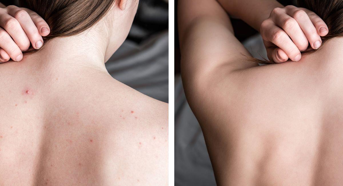 El mejor remedio casero combatir el acné en la espalda. Foto: Shutterstock
