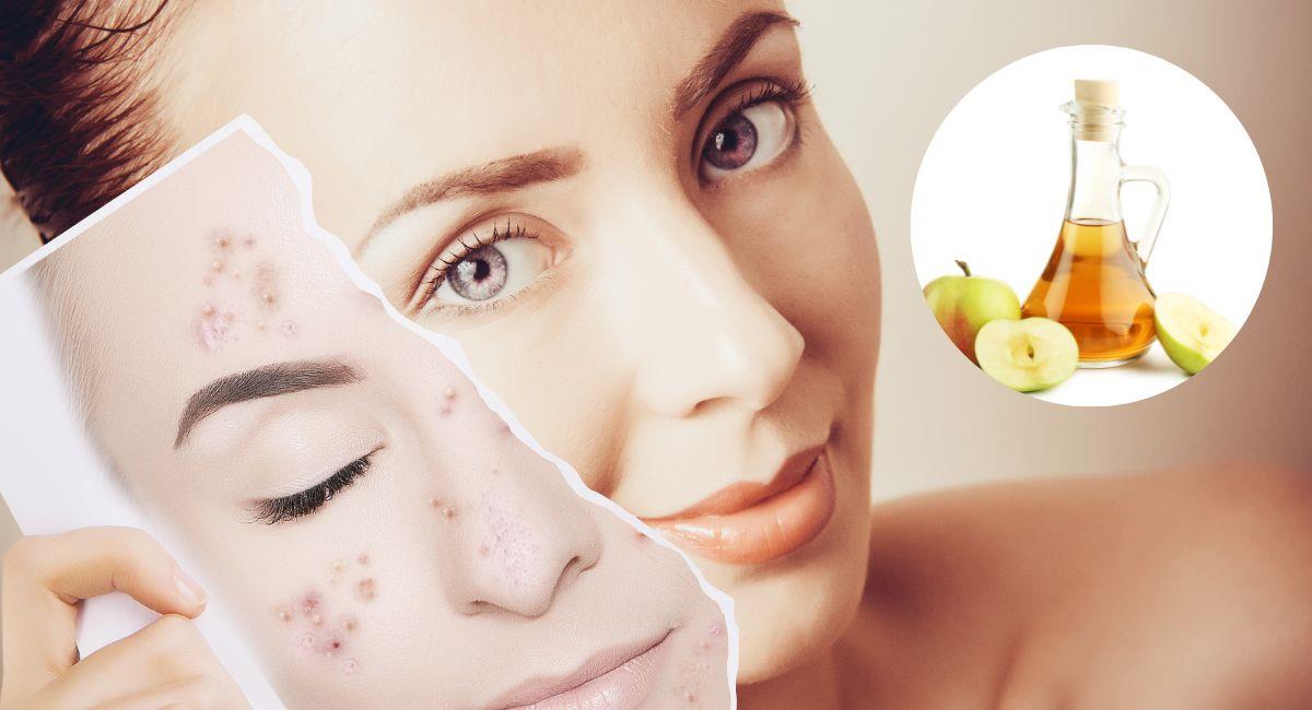 ¿Cómo quitar las manchas del rostro con vinagre de manzana?. Foto: Shutterstock