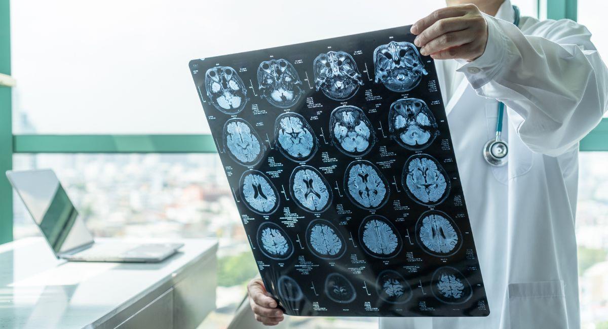 5 señales de que tu cerebro está envejeciendo muy rápido. Foto: Shutterstock