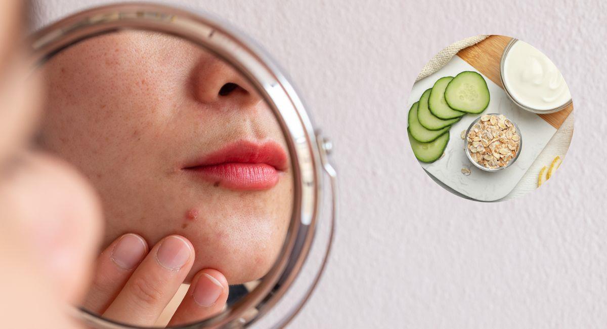 Mascarilla con dos sencillos ingredientes para tratar el acné. Foto: Shutterstock