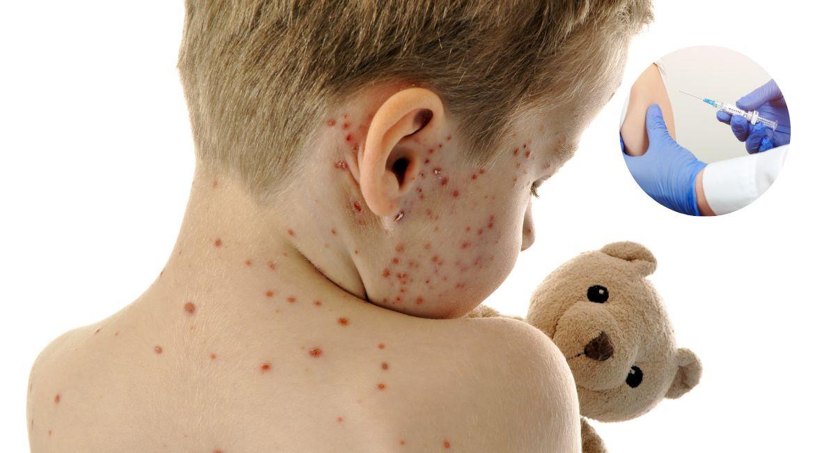 Si nunca tuvo varicela, debería vacunarse contra el herpes zóster. Foto: Shutterstock
