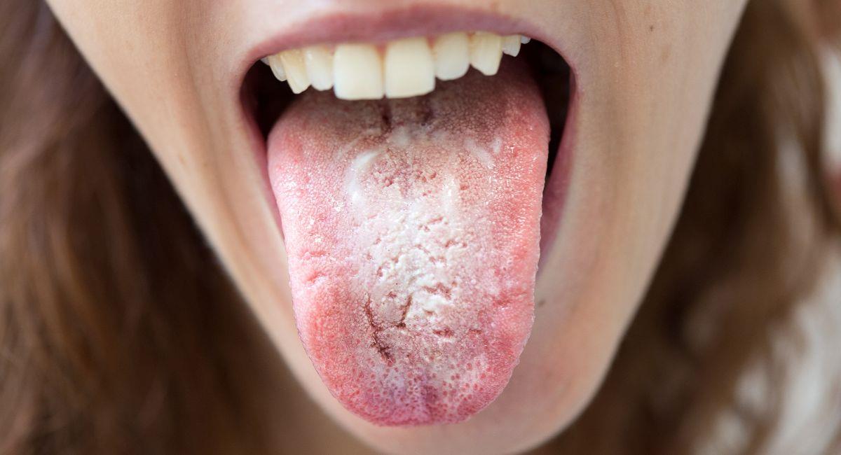 Esta podría ser la razón del porqué tienes la lengua blanca. Foto: Shutterstock