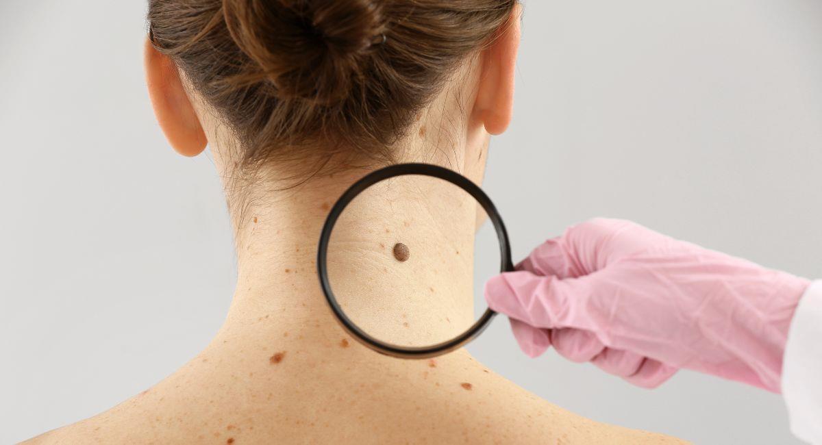 Vacuna contra el cáncer de piel estaría lista en 2025. Foto: Shutterstock